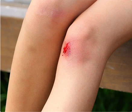 child with a scraped knee