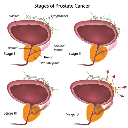 illustration showing 4 stages of prostate cancer