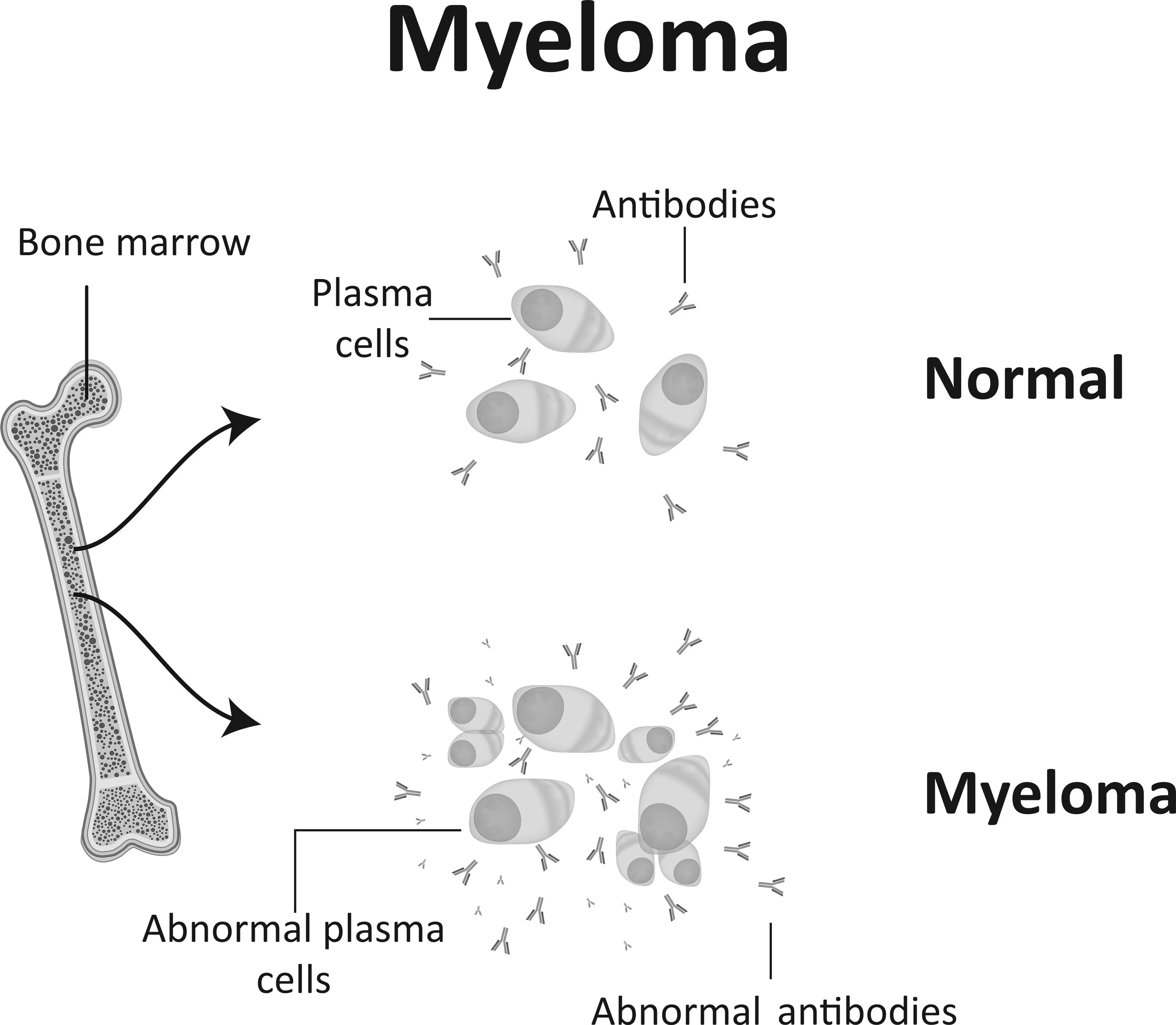 image showing a healthy bone marrow vs multiple myeloma