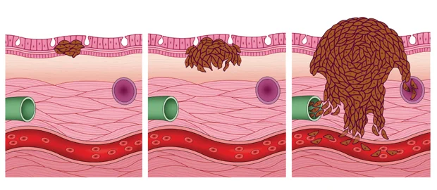 illustration showing 3 phases of sarcoma cancer developing in blood vessel