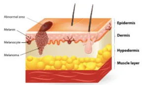 cutaway diagram of skin cancer