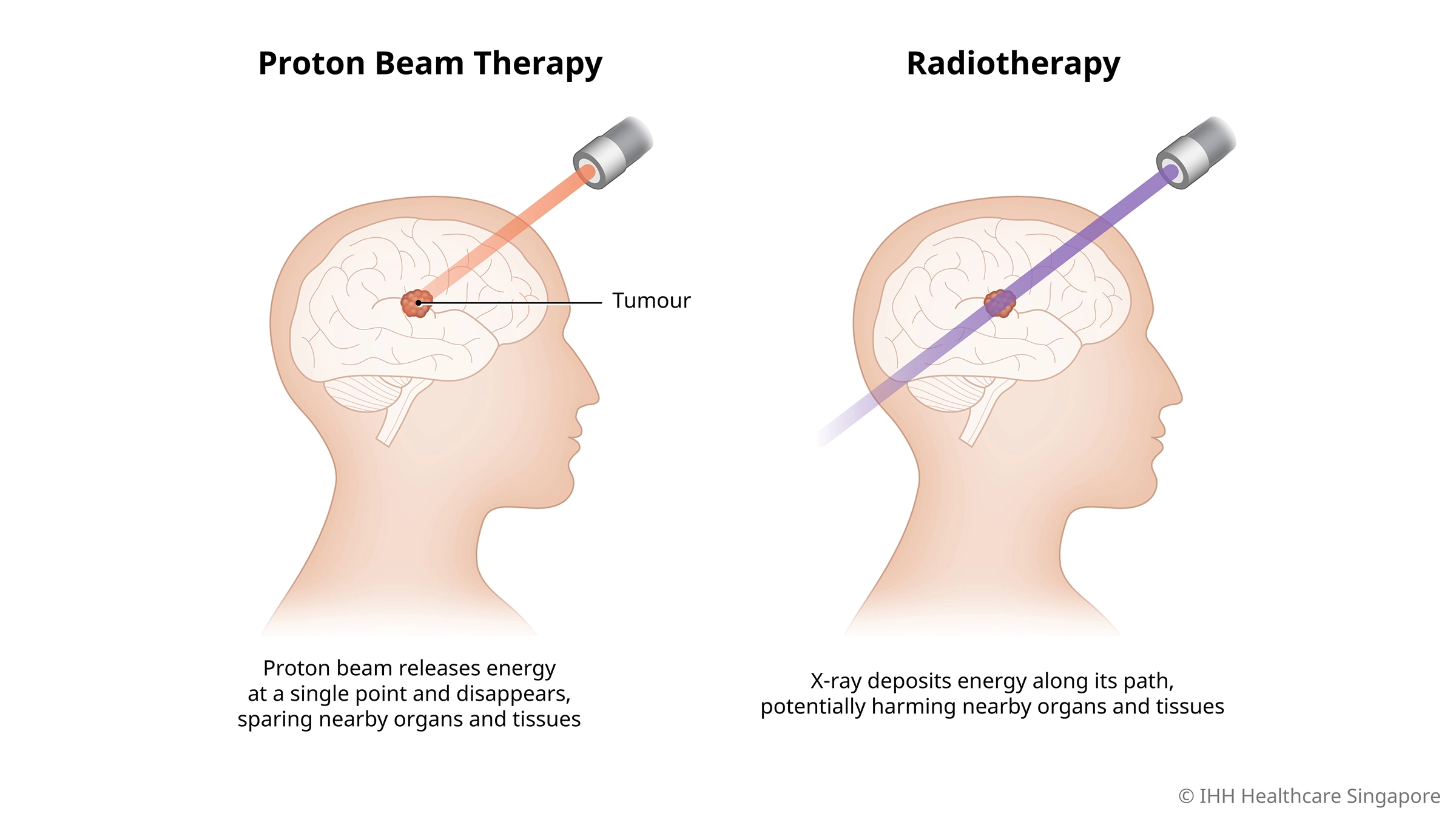 Proton Beam Therapy vs Radiotherapy
