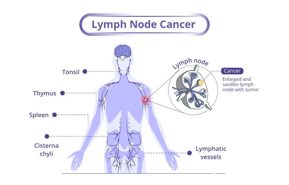 lymph node cancer anatomy
