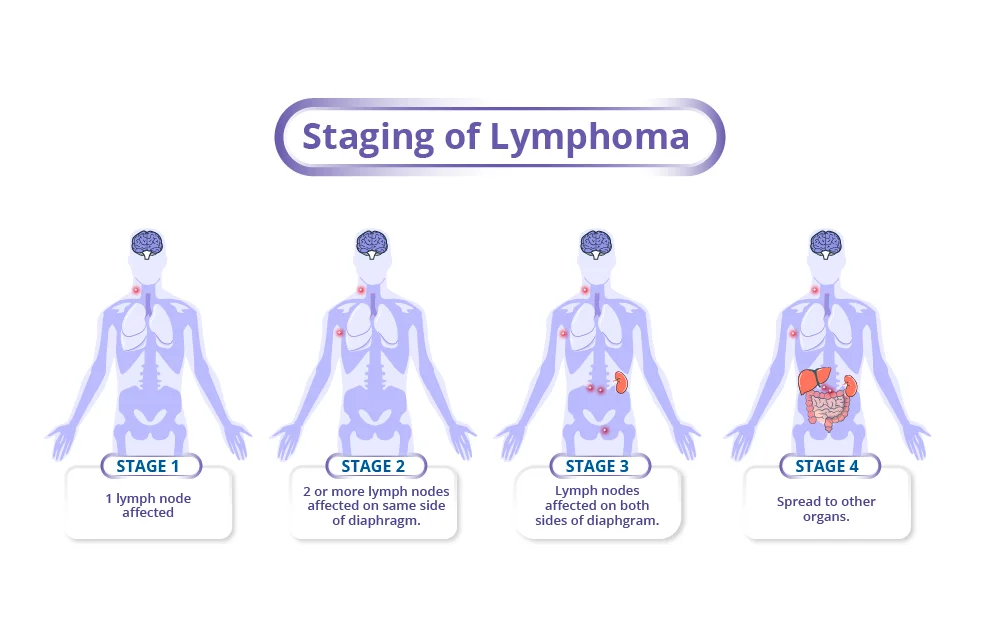 Staging of Lymphoma