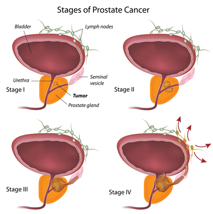 cancer prostate agressif forum