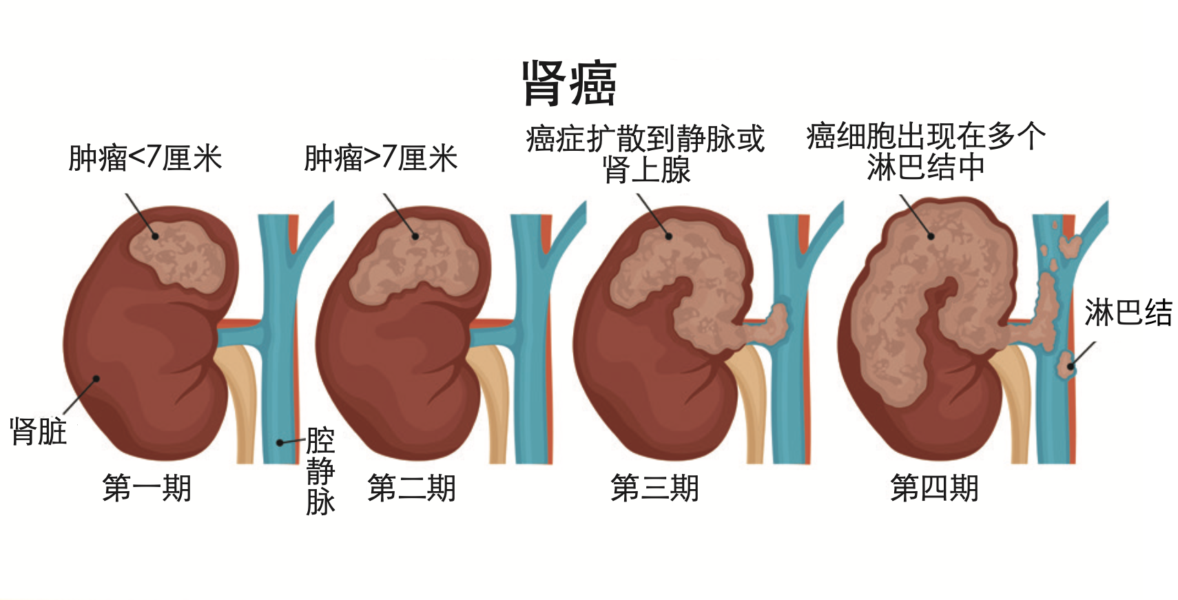 三、肾错构瘤-泌尿外科图像解剖-医学
