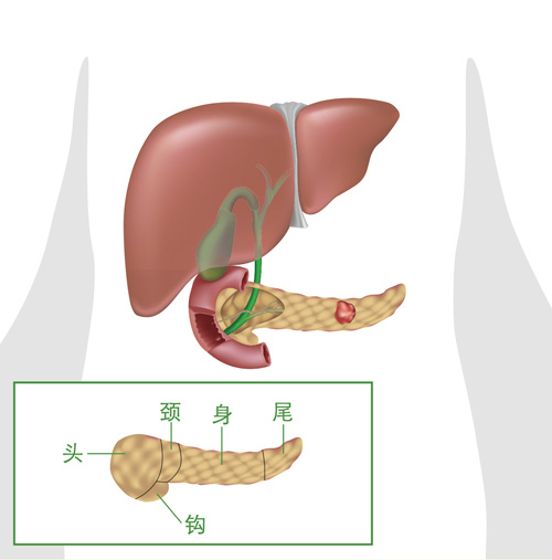 胰脏癌 胰腺癌 体征 诊断 及在新加坡接受治疗 百汇癌症中心新加坡