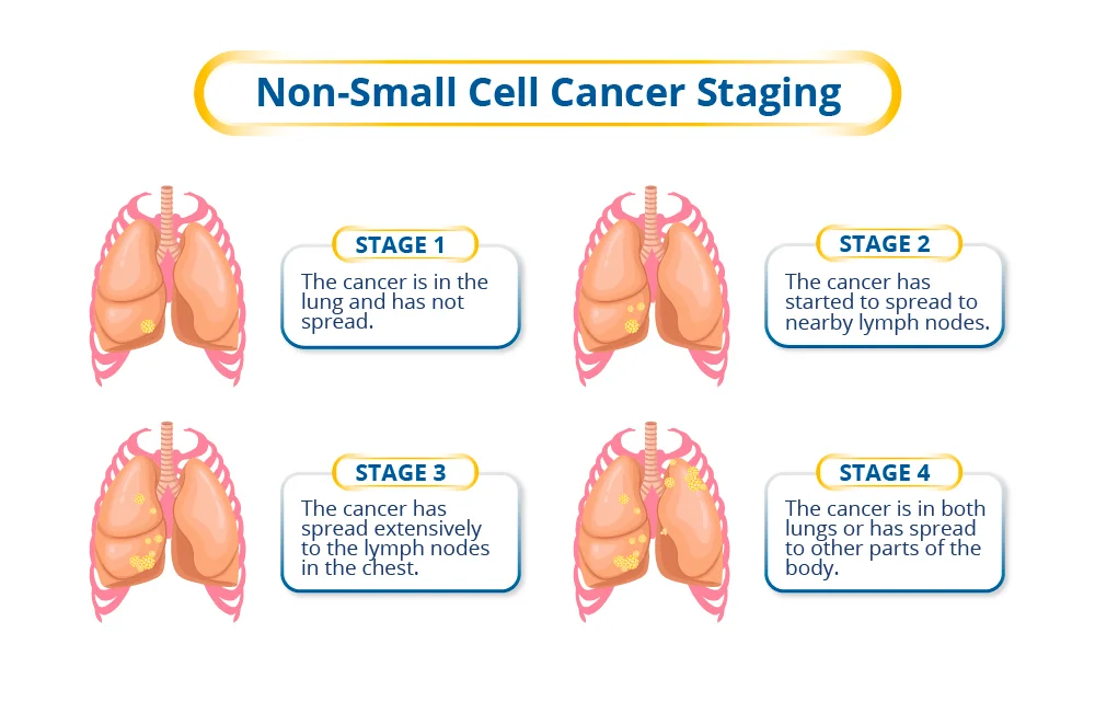 Stages of Non–Small Cell Lung Cancer