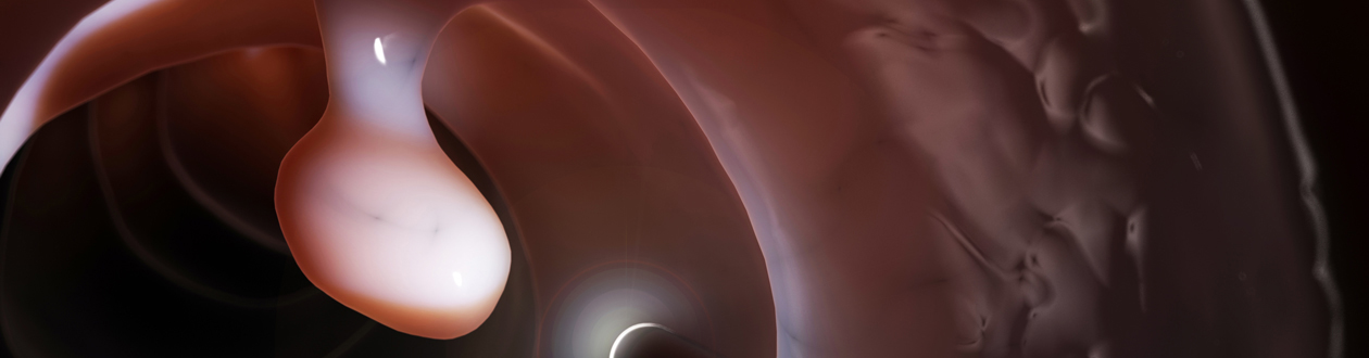 image of tumor in large intestine