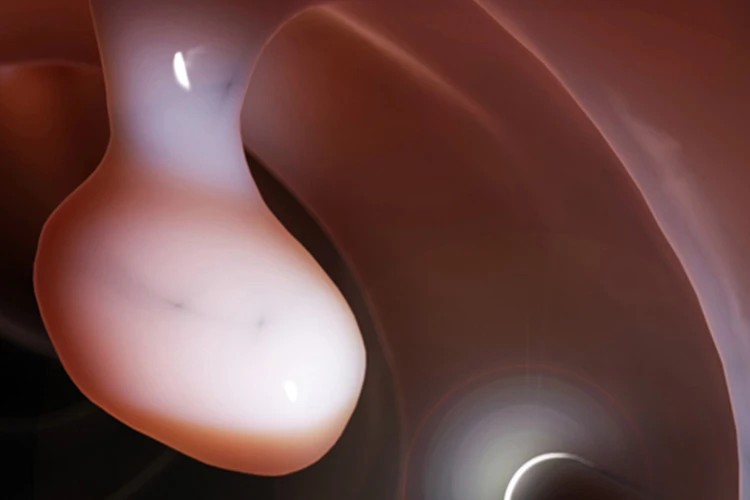 colorectal-cancer