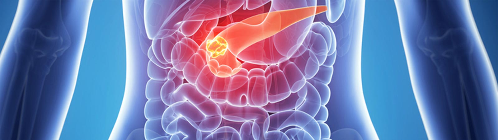 image of body x ray with tumor in pancreas