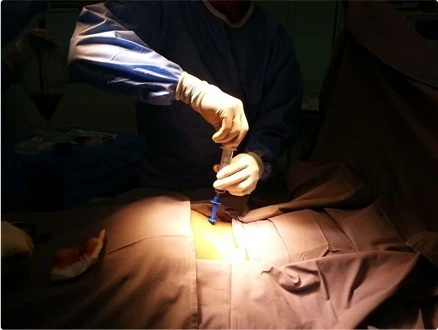 doctor performing a bone marrow aspiration on patient