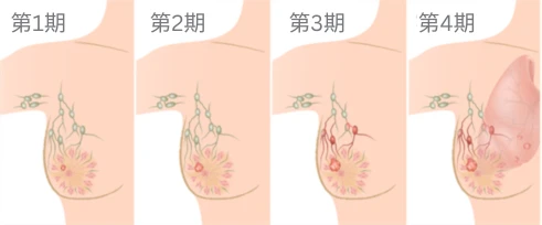 乳腺癌的阶段