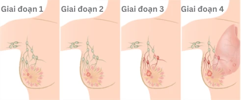 Các giai đoạn của ung thư vú