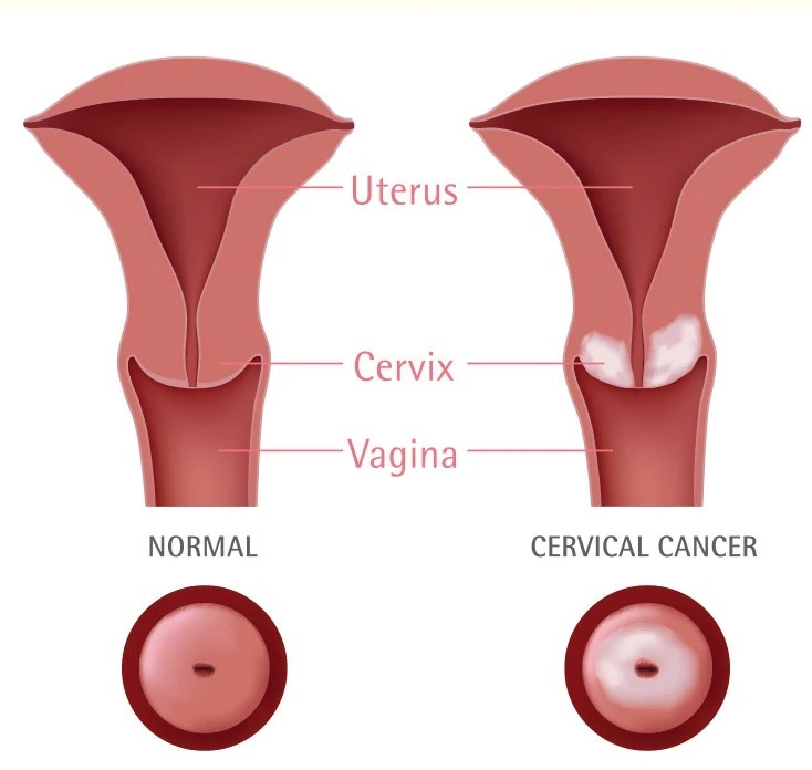 diagram comparing a normal cervix with cervical cancer which had abnormal cells appearing in cervical tissue