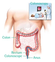 diagram showing colposcopy procedure whereby doctor examines rectum and entire colon using a long lighted tube