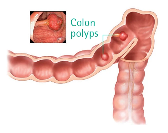 illustration of polyps in colon