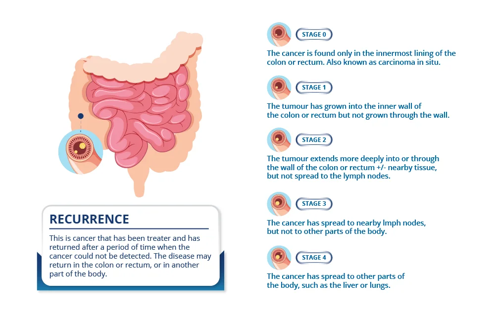Stages of Colon Cancer