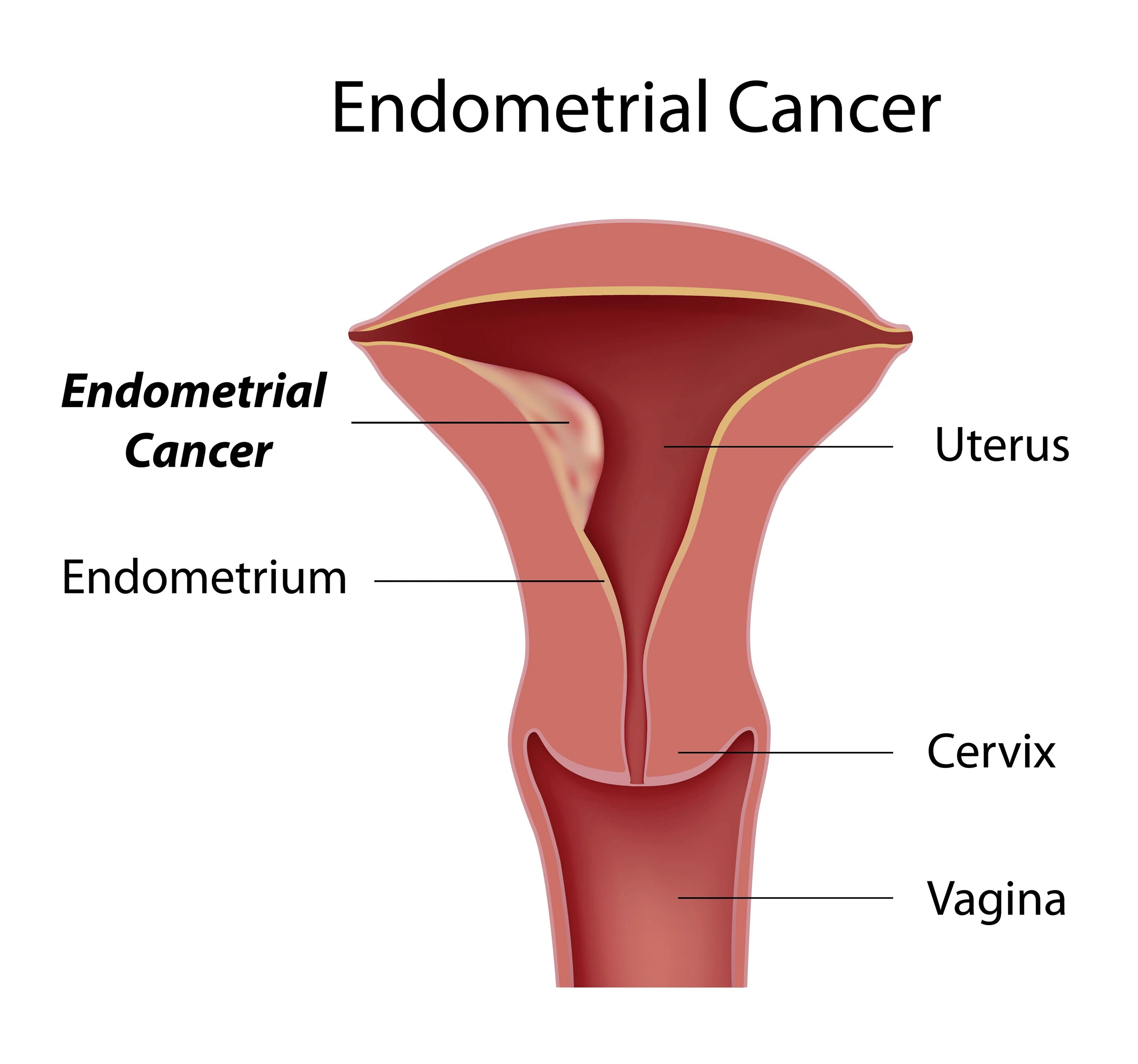 uterine cancer tumor in uterus anatomy