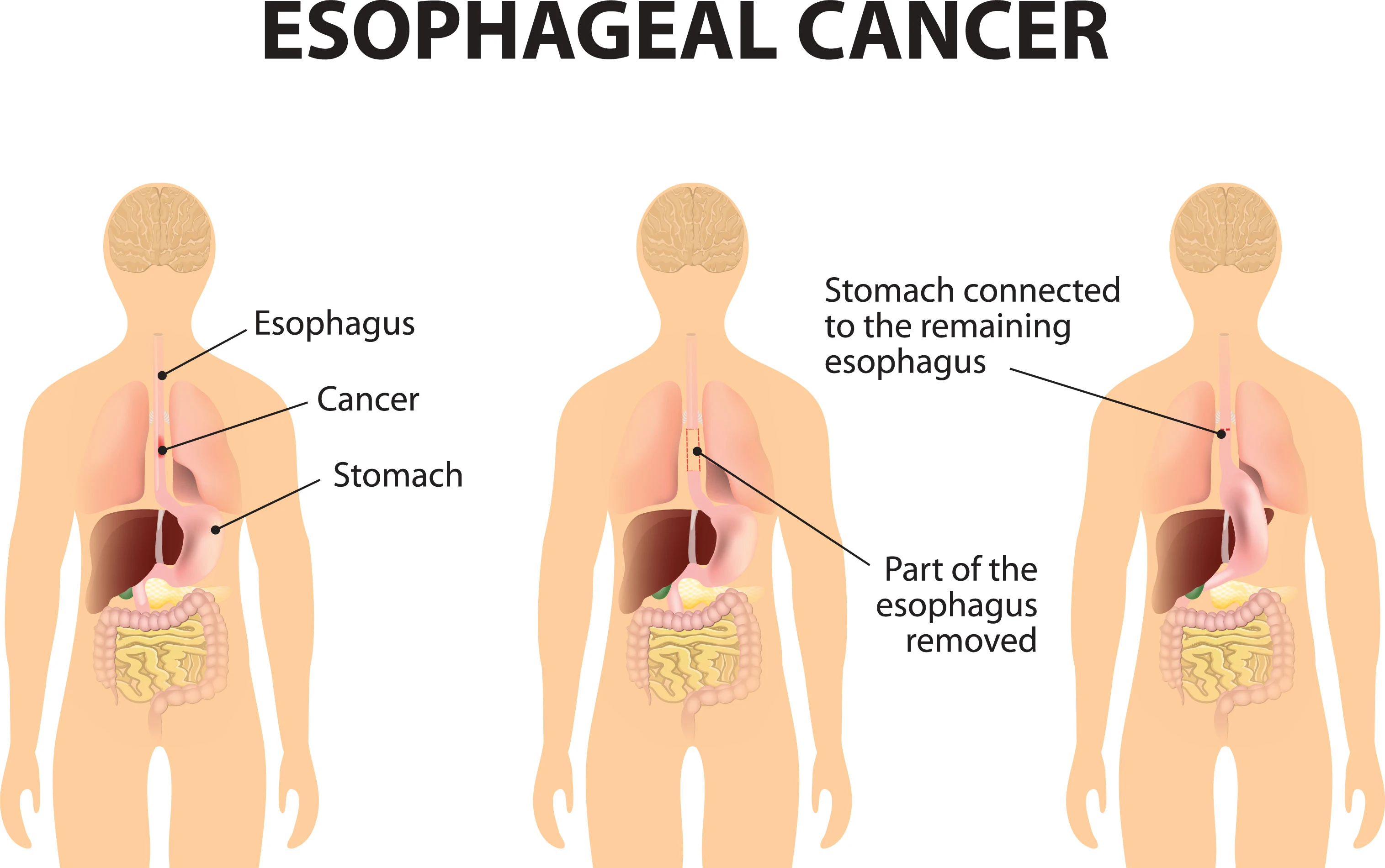 diagram of espohageal cancer surgey showing part of esophagus removed and stomach connecting to the remaining esophagus