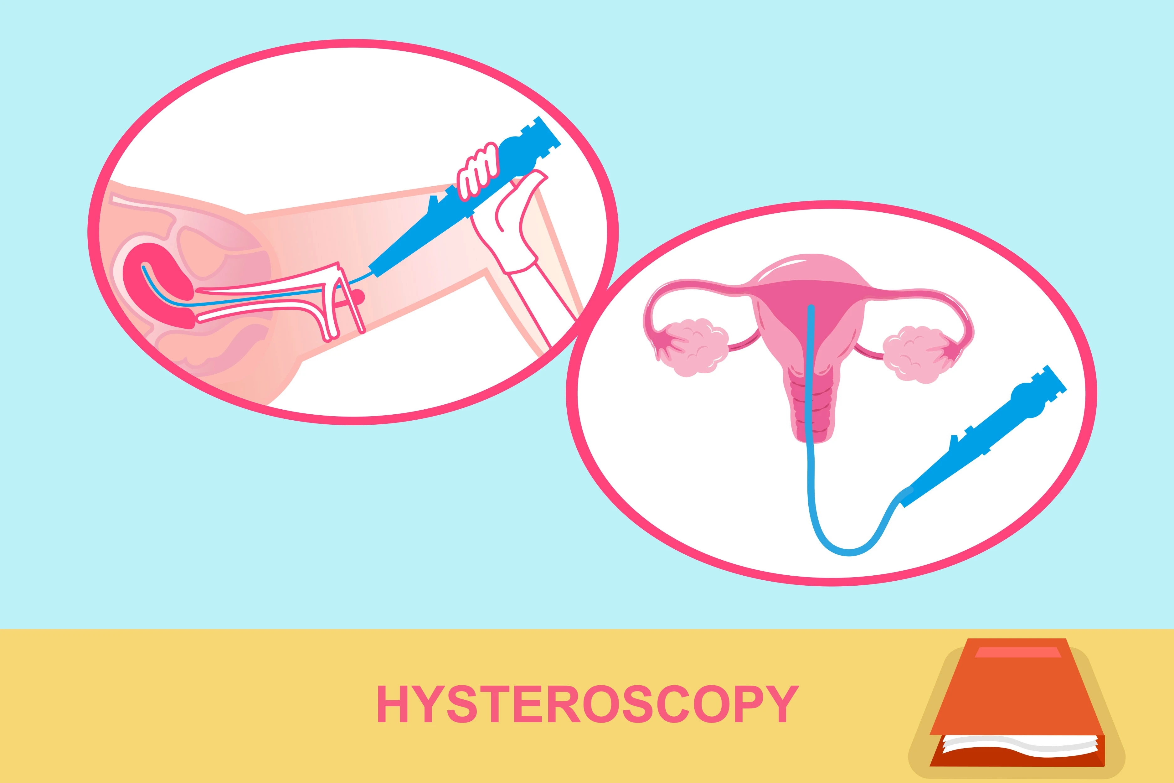 diagram showing hysteroscopy procedure which involves insertion of a small thin, lighted tube through the vagina and cervix into uterus