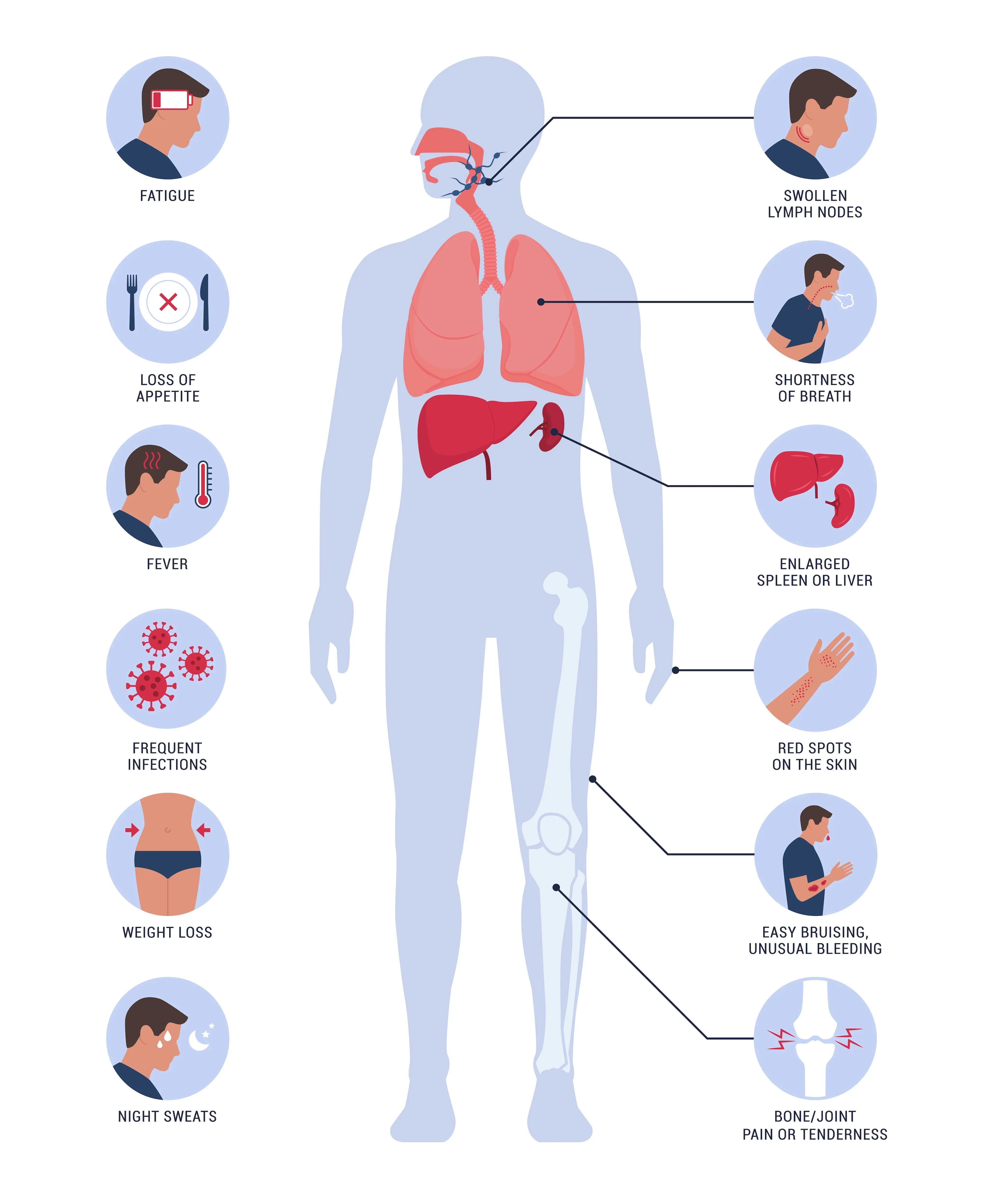 lymphoma infographic