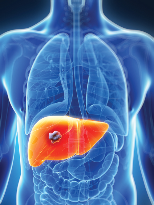 human body diagram with tumor in liver