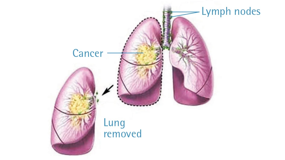diagram of lungs with lymph nodes and cancer tumor