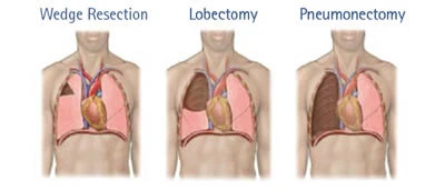 diagram of wedge resection lobectomy and pneumonectomy