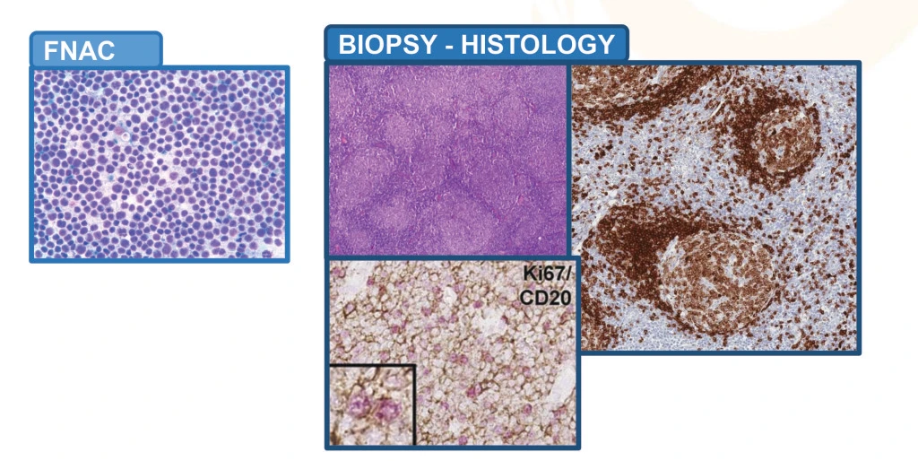 lymph nodes biopsy microscopic images