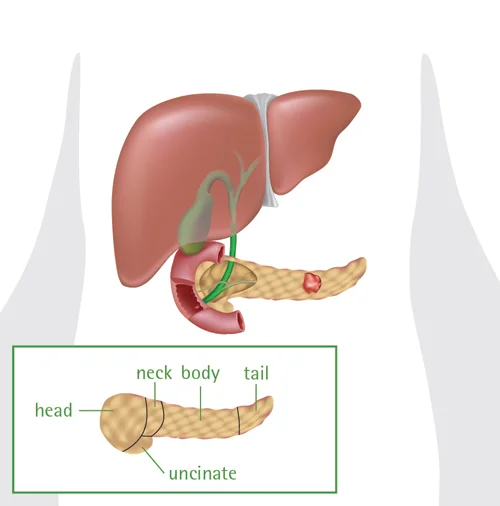 illustration of liver gallbladder and tumor in pancreas