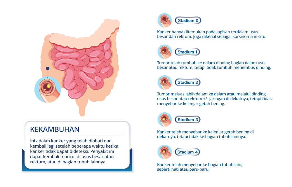 Stages of Colon Cancer
