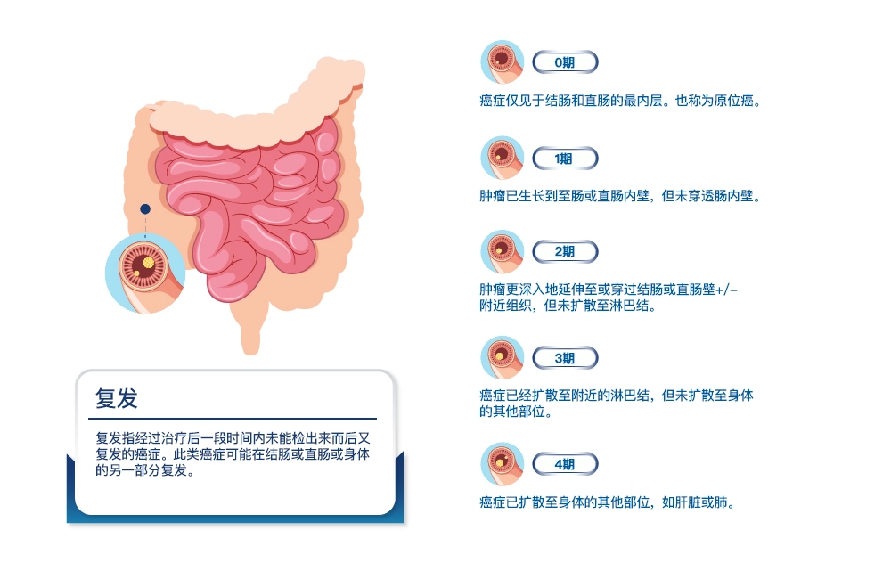 Stages of Colon Cancer
