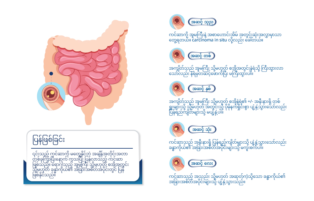 Stages of Colon Cancer