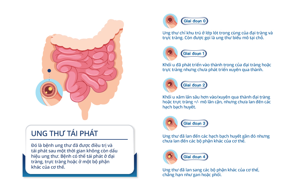 Stages of Colon Cancer