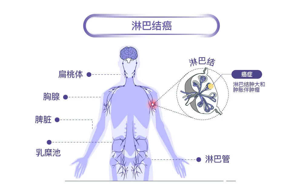 淋巴结癌解剖
