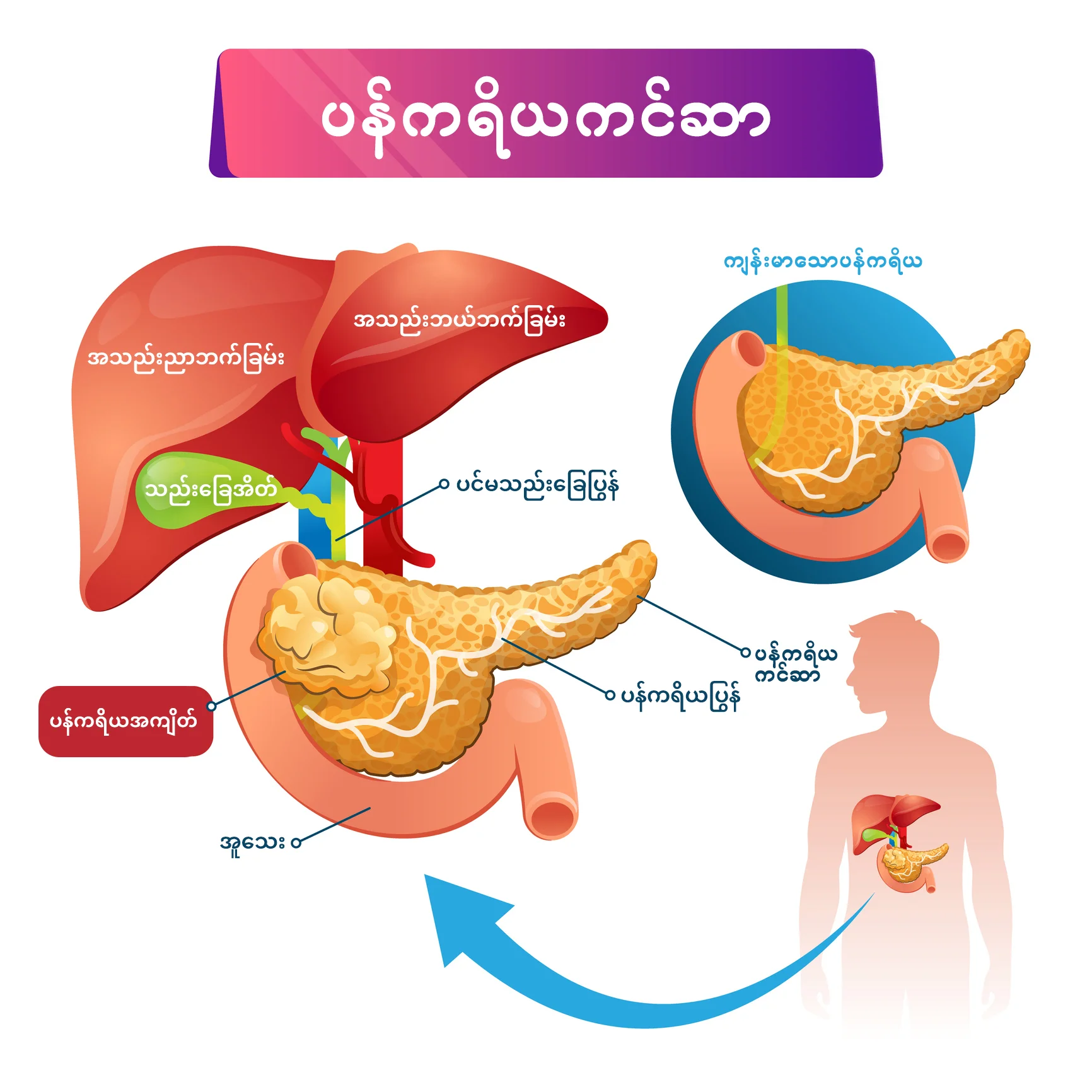 ပန်ကရိယကင်ဆာ infographic