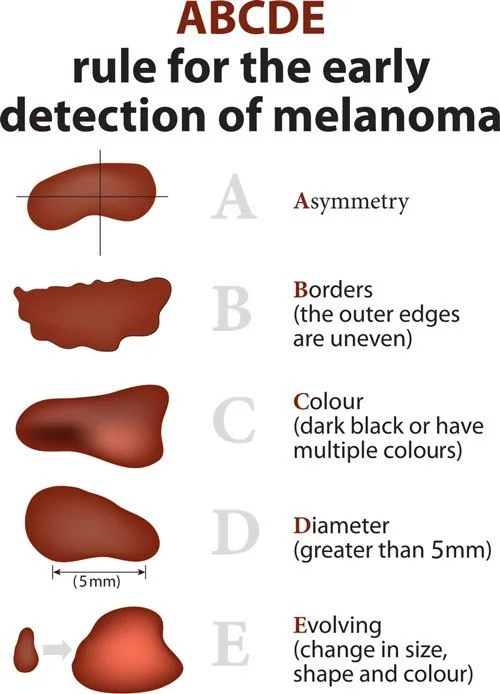 ABCDE rule and melanoma warning signs with images