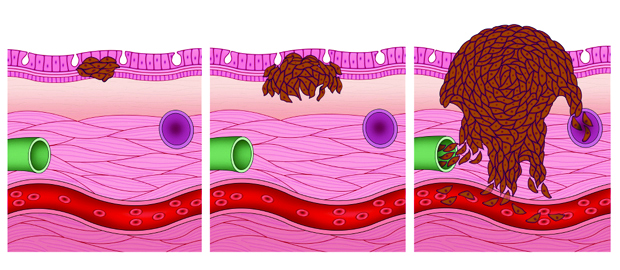 illustration showing 3 phases of sarcoma cancer developing in blood vessel