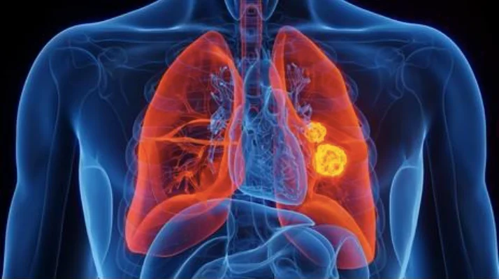 Lung Cancer Anatomy