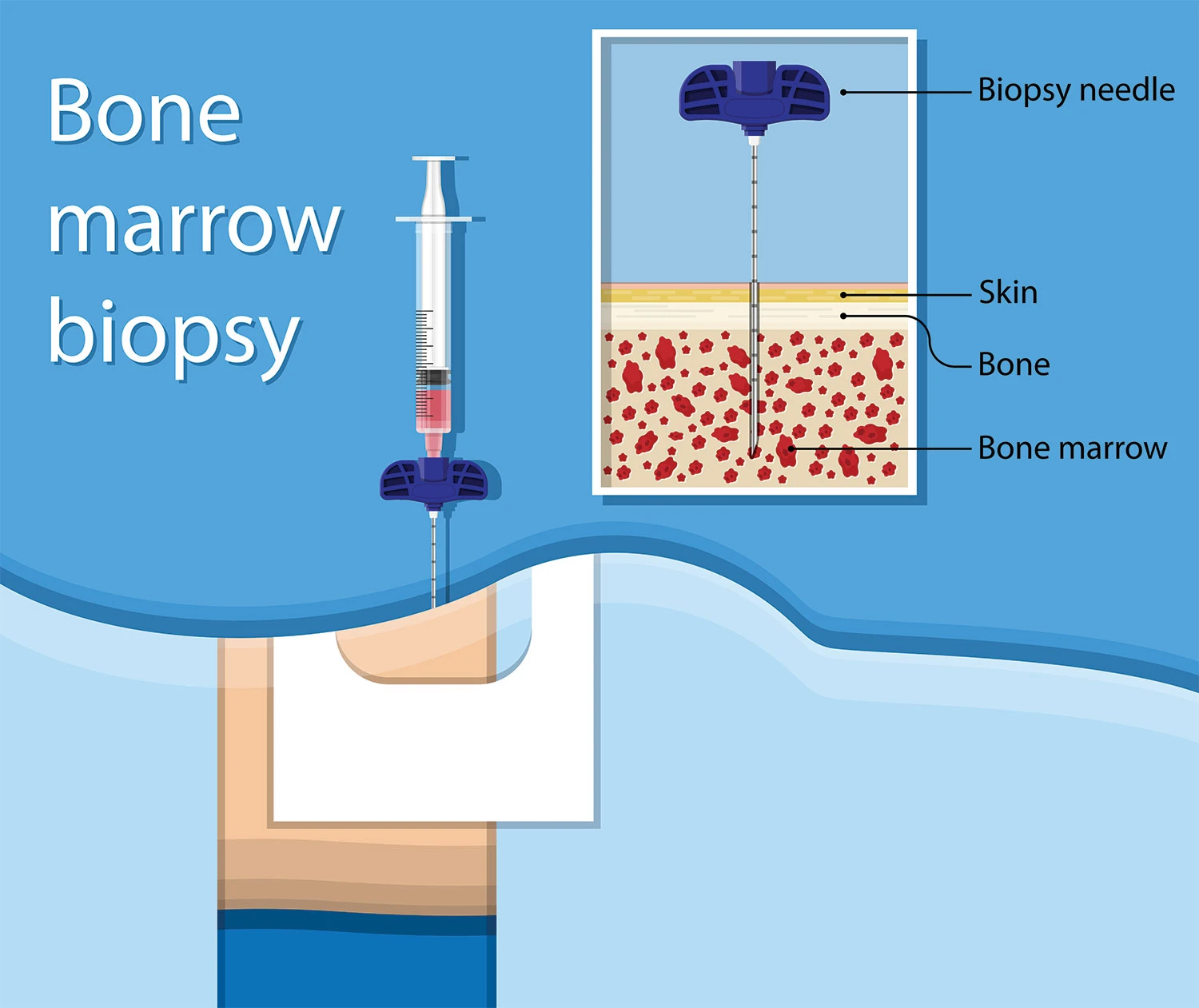 image showing how the bone marrow biopsy is done