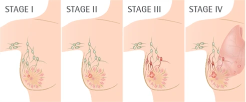 stages of breast cancer