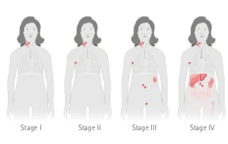 woman in 4 different stages of lymphomas developing
