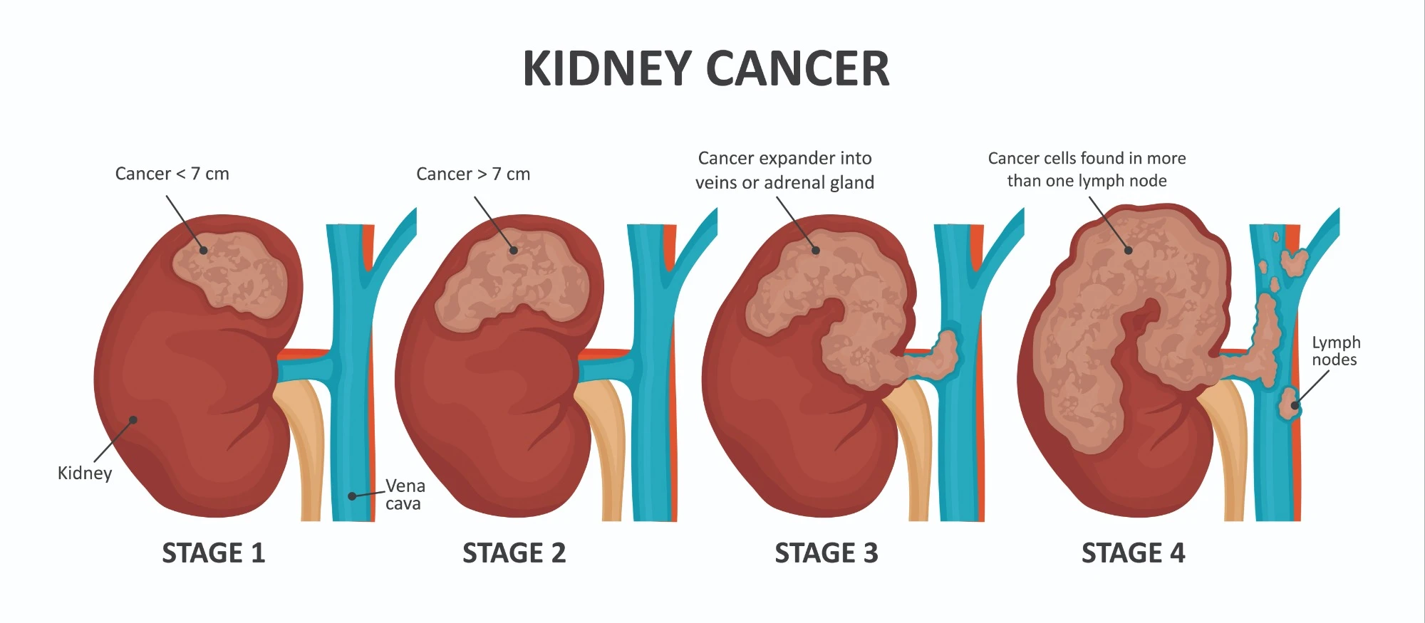 diagram showing development of kidney cancer in 4 stages