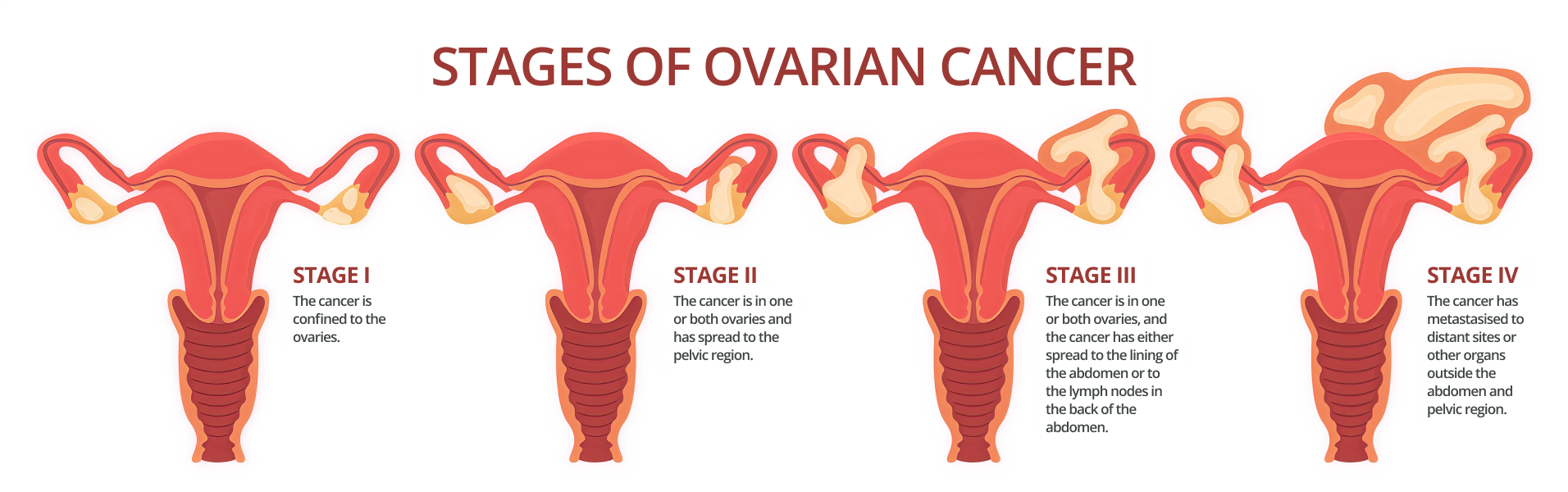 illustration of cancer stages