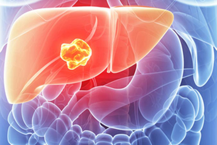 liver-cancer liver-cancer