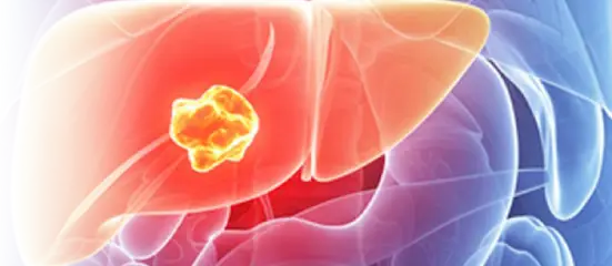 Liver Cancer