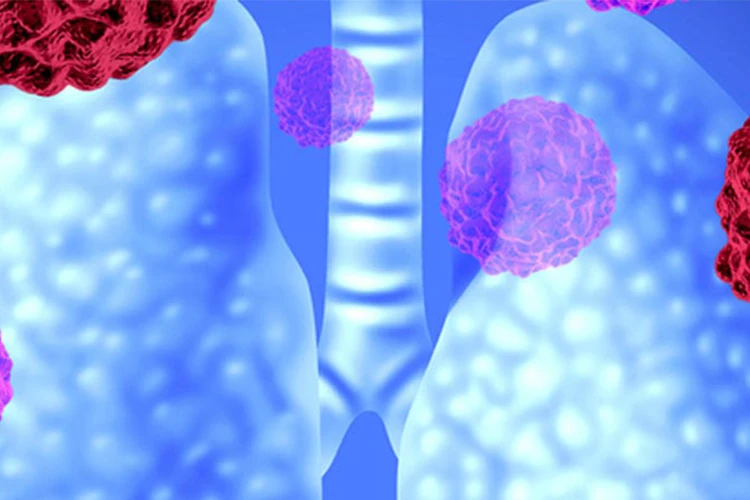 close up image of lung tumor x ray