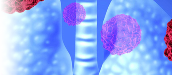 Lung Cancer (SCLC, NSCLC)