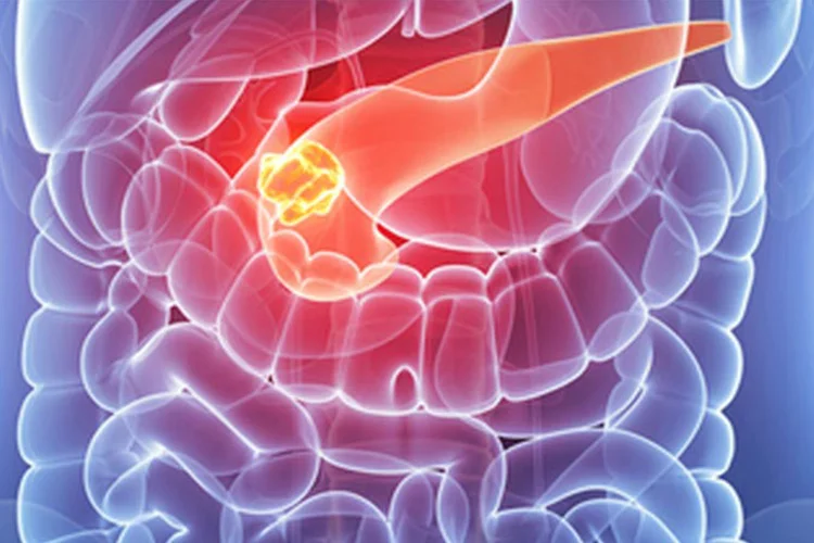 image of body x ray with tumor in pancreas